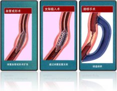 怎樣治療冠心??？